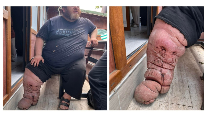 Keşanlı Kazım Atak hastalığı için yardım bekliyor